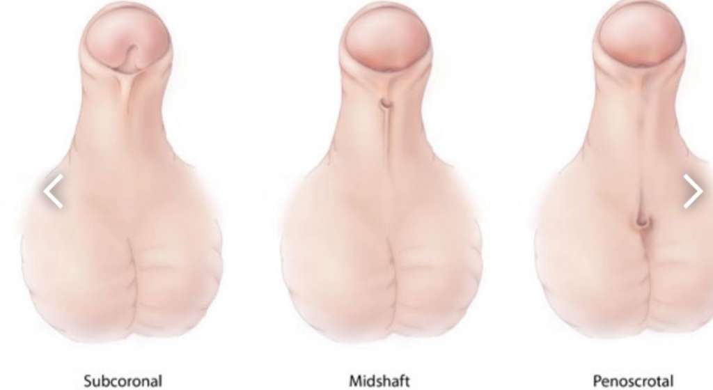 Les différents types d’hypospadias