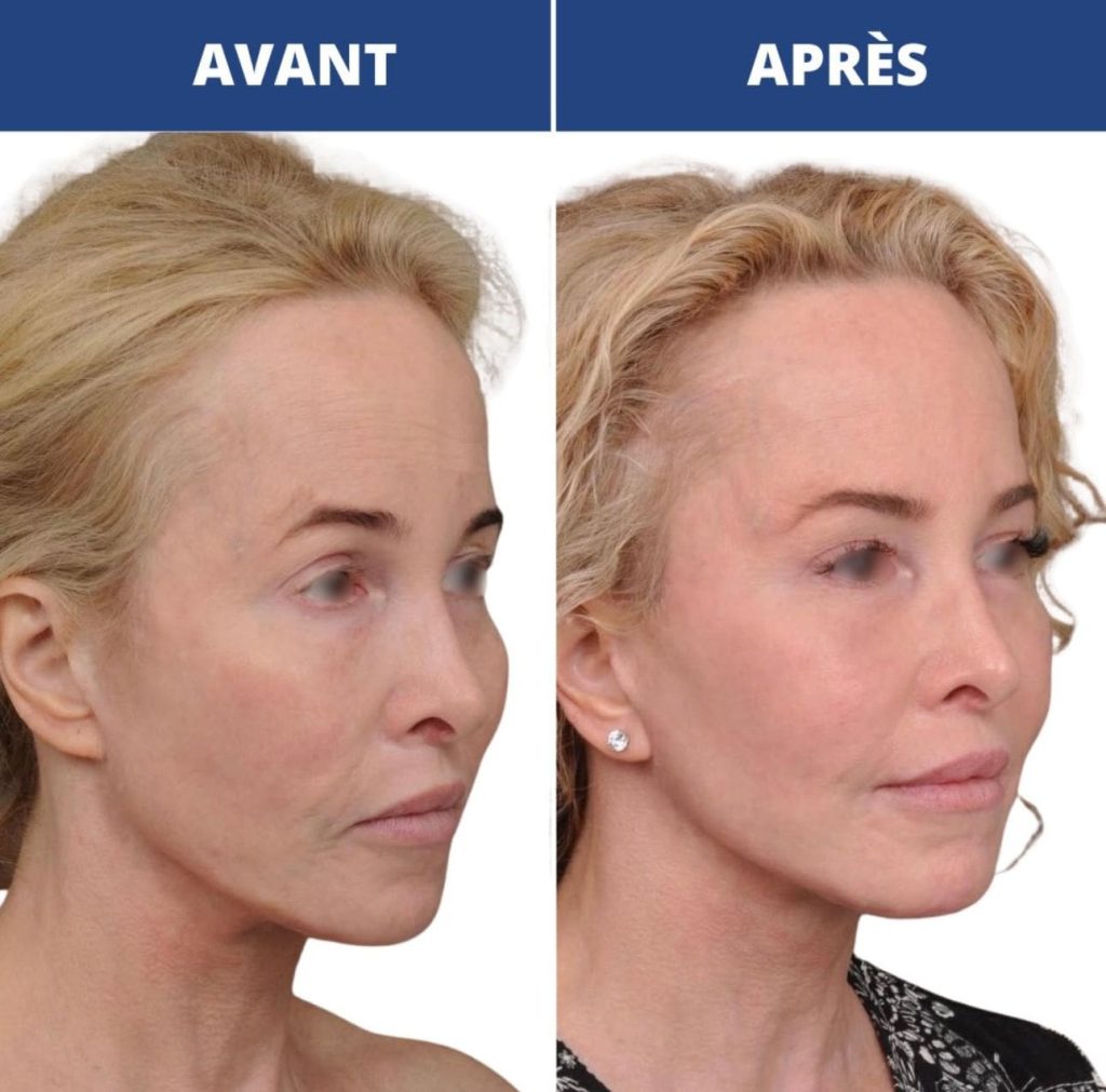 Comparaison de 2 liftings de visage avant après