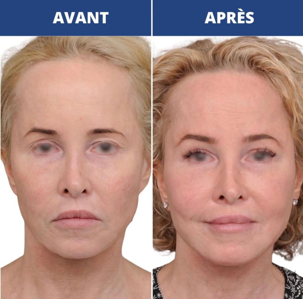 Comparaison de 2 liftings de visage avant après