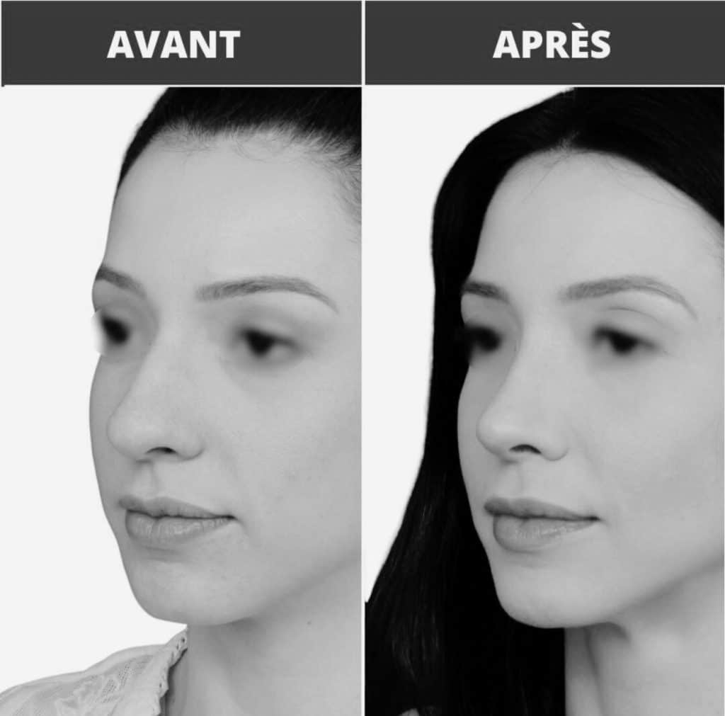 Avant après rhinoplastie sur une femme