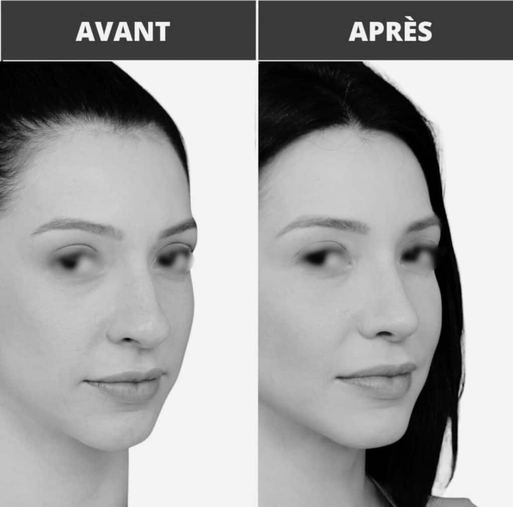 Avant après rhinoplastie sur une femme