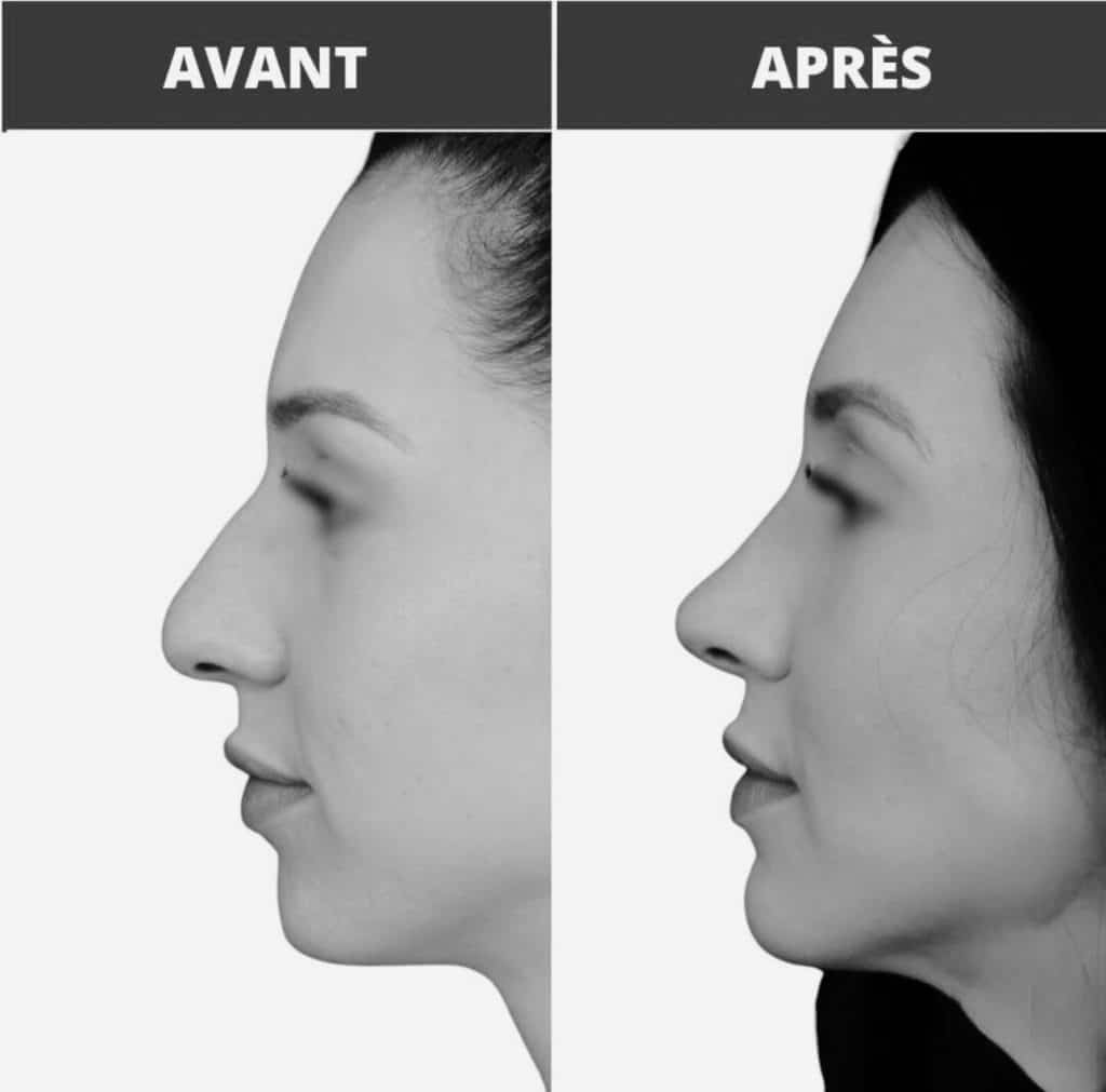 Avant après rhinoplastie sur une femme