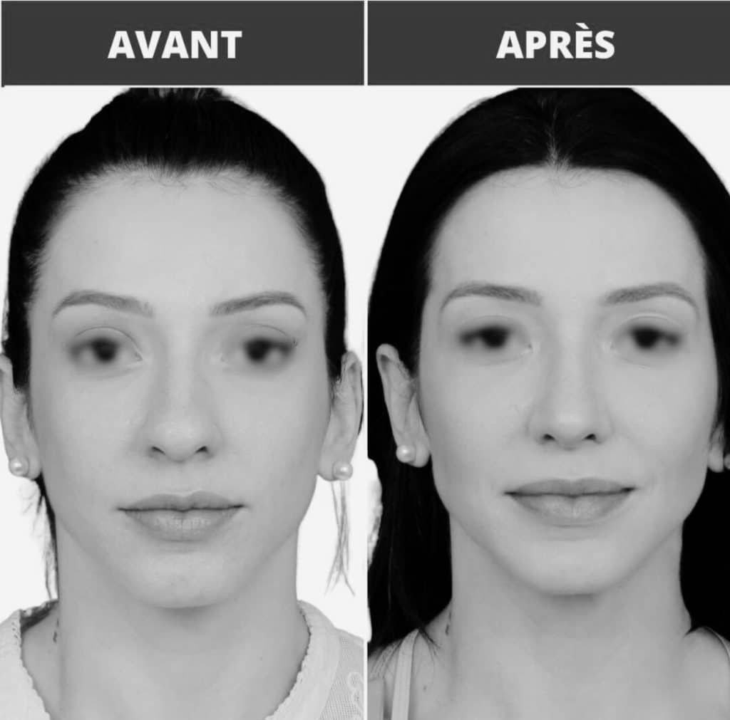 Avant après rhinoplastie sur une femme
