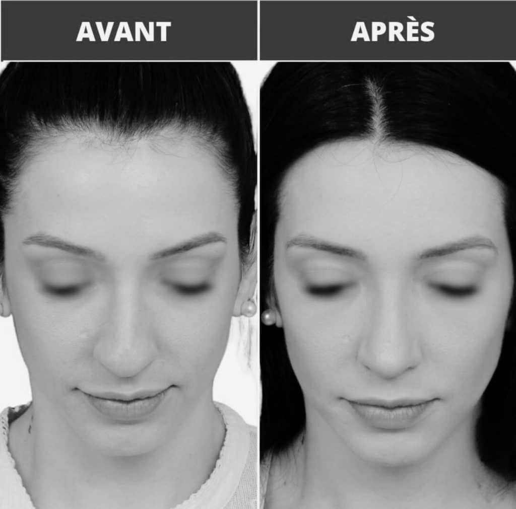 Avant après rhinoplastie sur une femme