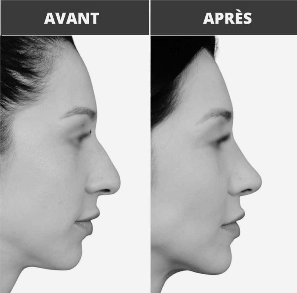 Avant après rhinoplastie sur une femme