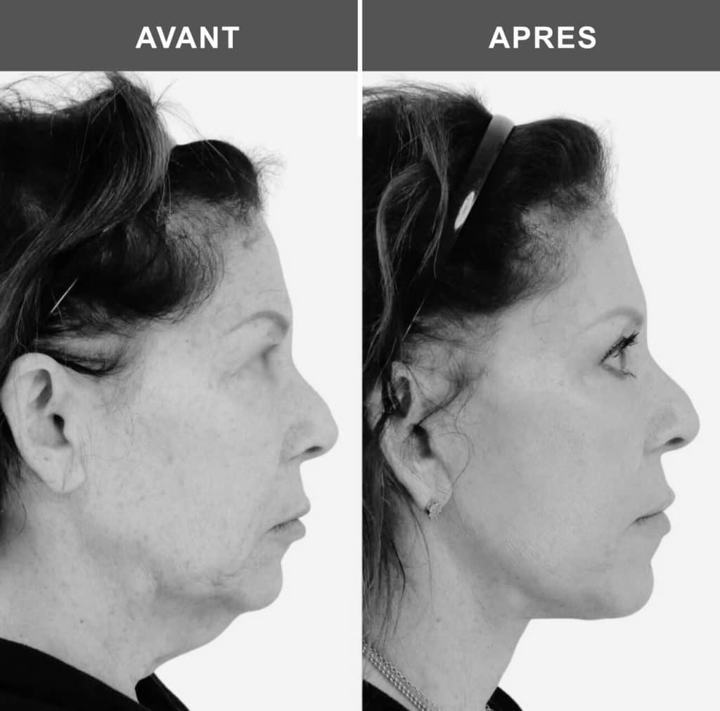 lifting du cou avant après