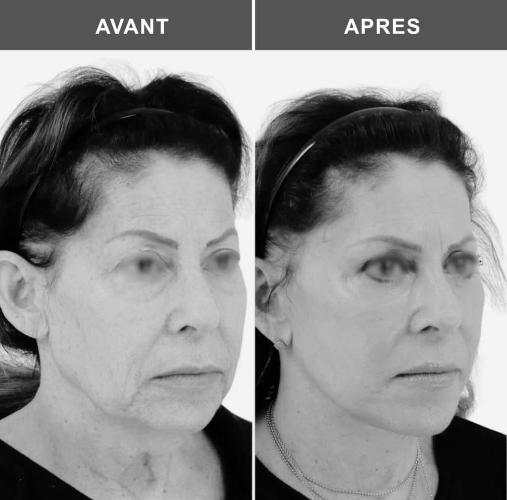 lifting du cou avant après