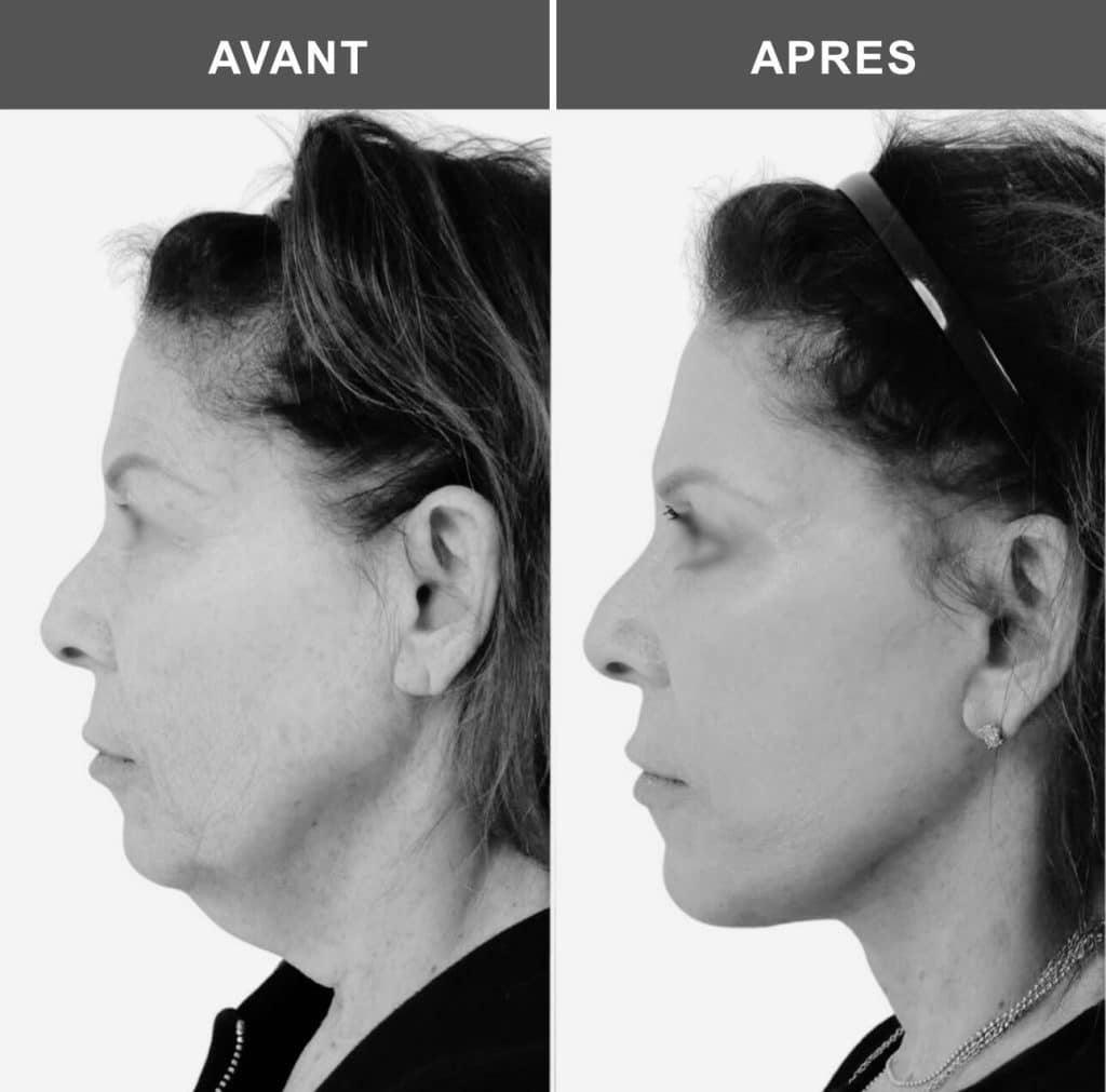 lifting du cou avant après