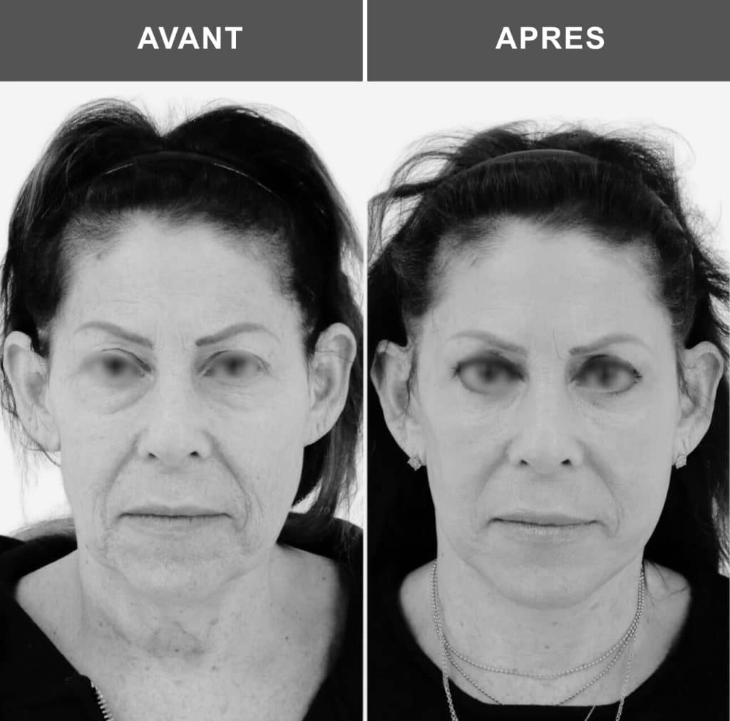 lifting du cou avant après