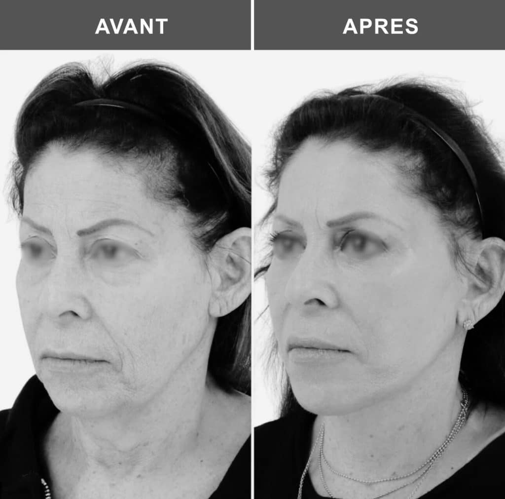 lifting du cou avant après